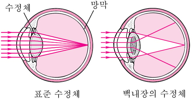 백내장(성인)