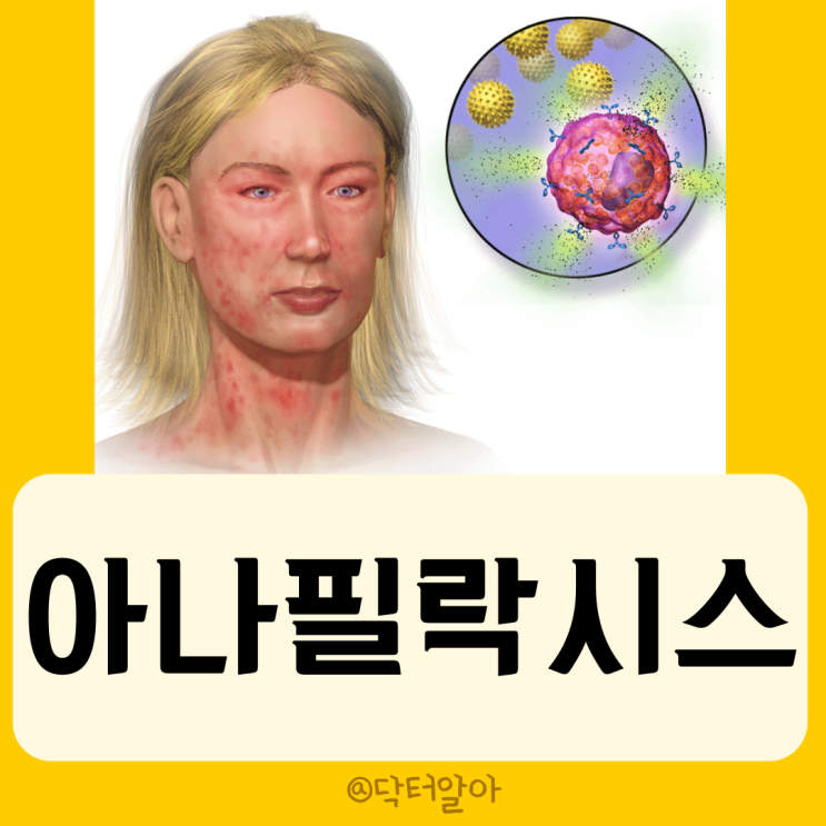  아나필락시스(Anaphylaxis)의 정의, 증상, 진단 및 치료