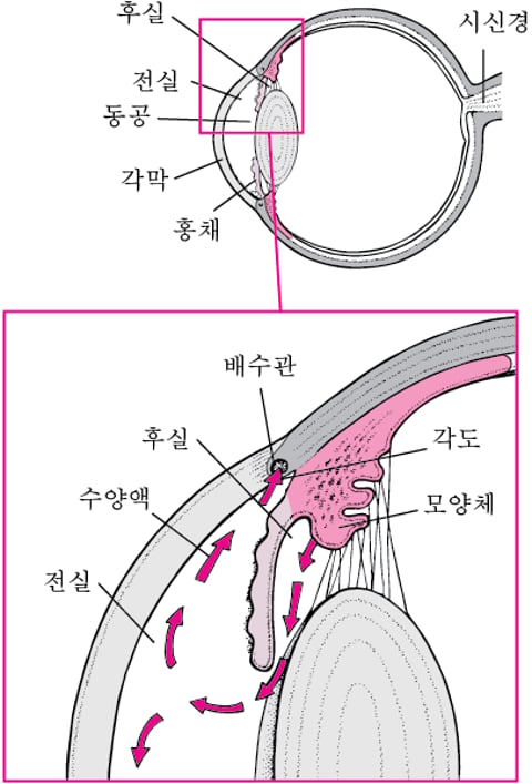 원발성 유아 녹내장(유아 녹내장, 선천성 녹내장, 우안증)