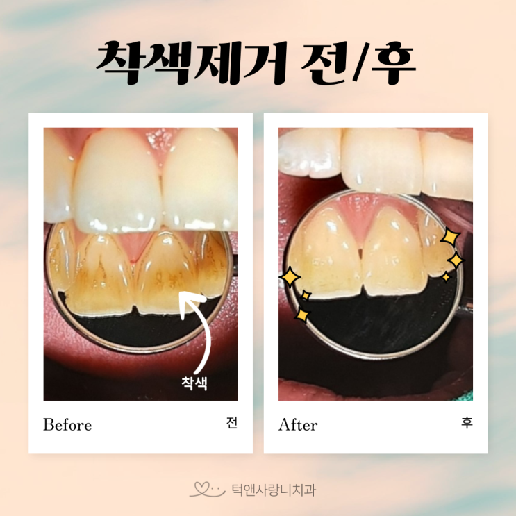  천안 치아 검정색, 담배 착색 제거 잘 하는 곳
