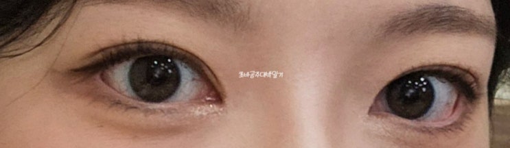  짝눈 쌍수 절개 +앞트임 눈매교정 후기 내돈내산 ~1년까지의 후기