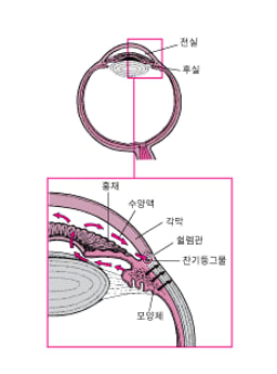 녹내장(성인)