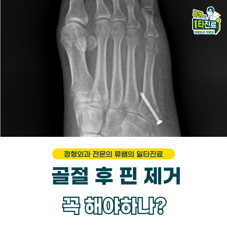  발등뼈 골절 핀 제거 시기 및 제거 이후 회복 과정  (의사작성)
