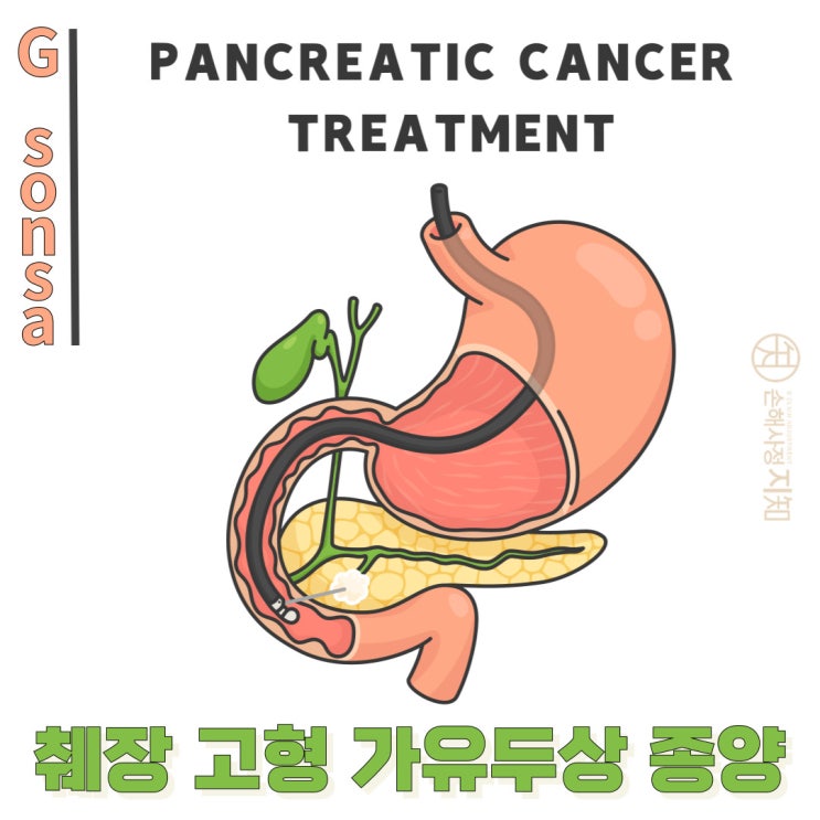  [엄마의 질병] 3. 췌장 고형 가유두상 종양(SPT) - 드물지만 중요한 조기 발견