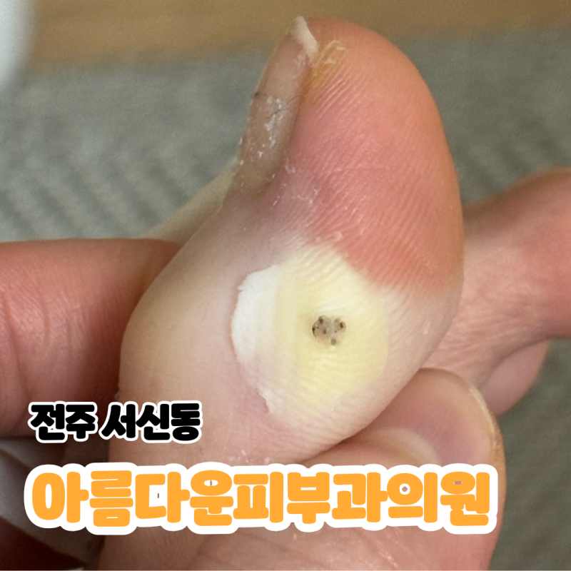 [전주/서신동] 발가락 티눈 약국, 발가락 사마귀 피부과 레이저 치료