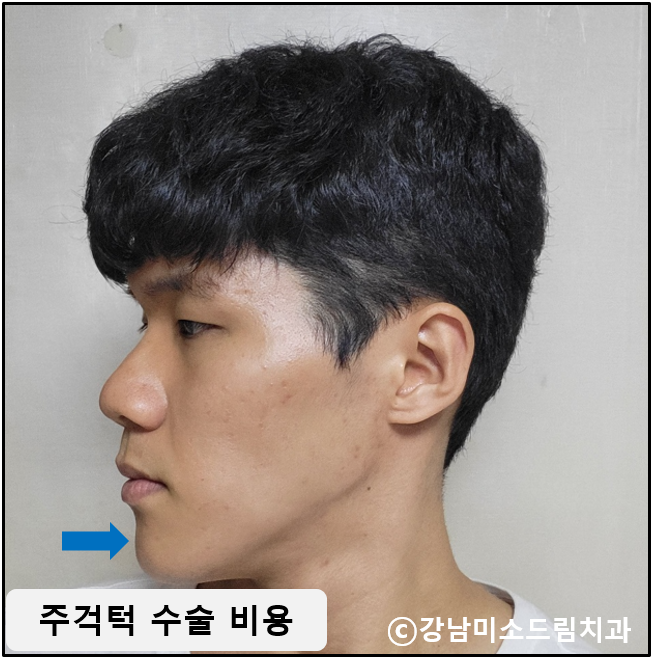 주걱턱 수술 비용 절반 안되는 교정 치료
