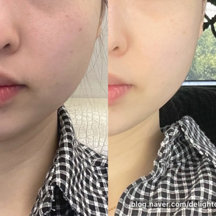 광주 리니어지 리프팅 솔직후기 (다운타임 없음) 광주 리니어지 리프팅 솔직후기 (다운타임 없음)