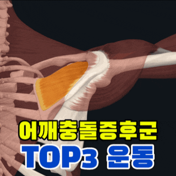  강동구 천호 헬스장 어깨충돌증후군 방치하면 큰일 납니다