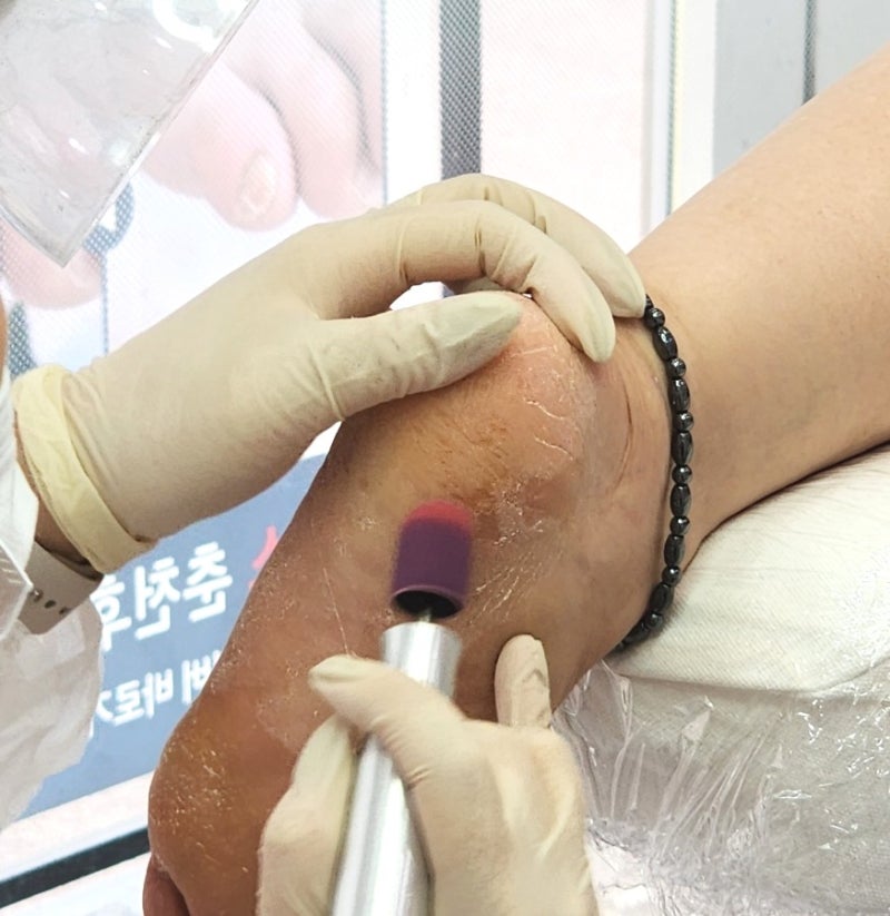 춘천 발각질 | 발관리 전문점, 발각질 및 굳은살 제거 후기 | 레푸스 춘천후평점