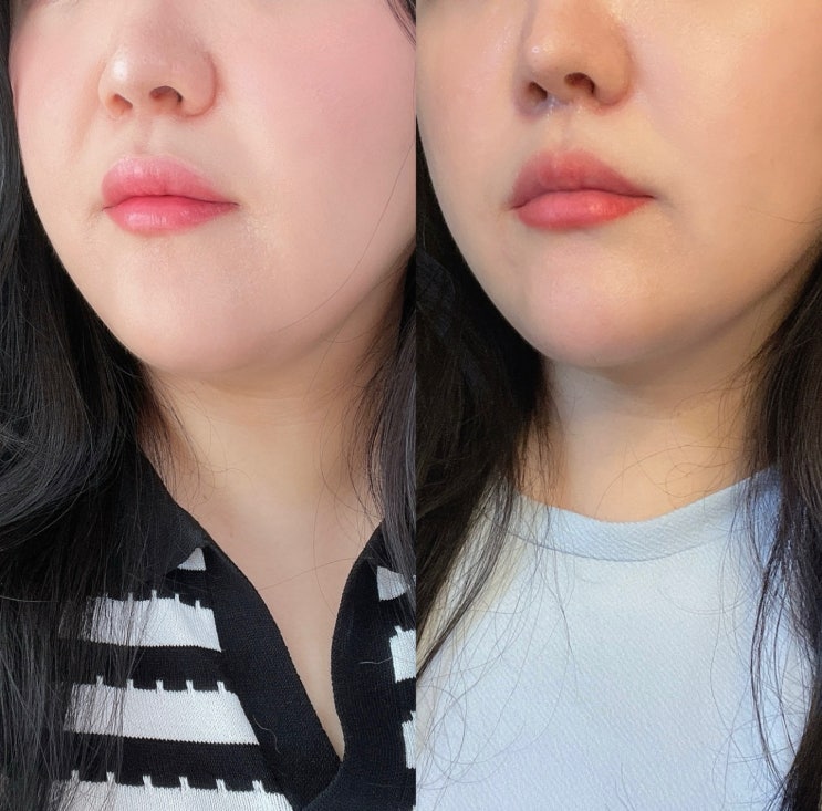  서면피부과 할만했던 텐쎄라 200샷 400라인 1회차 후기