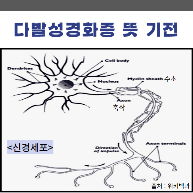 다발성경화증 뜻 원인 병태생리 발생 기전