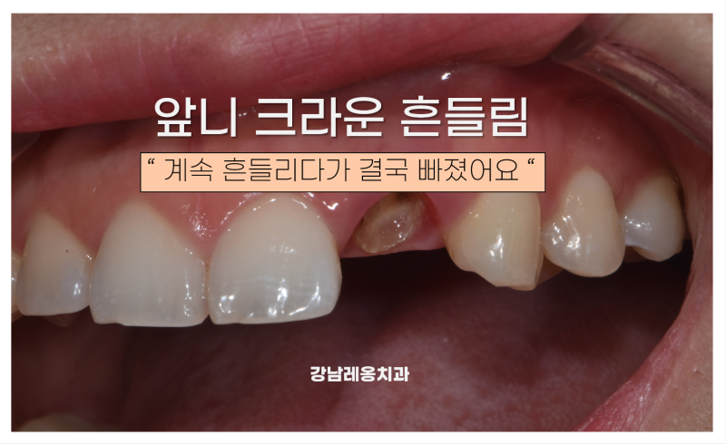 앞니 크라운이 빠짐, 부러짐 대처 방법 / 발치 대신 재치료로 치아의 수명을 연장한 사례 / 강....