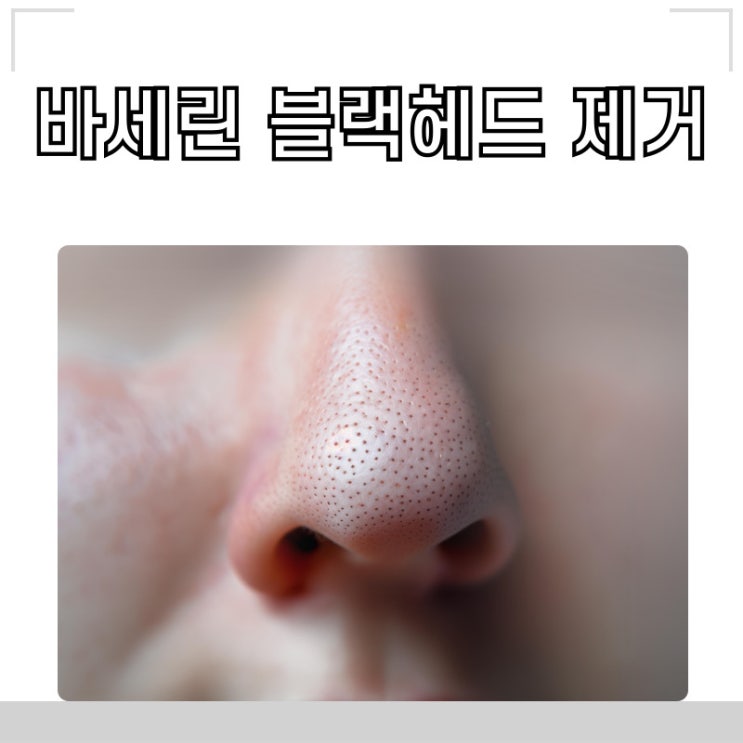 바세린으로 피지제거 하세요.