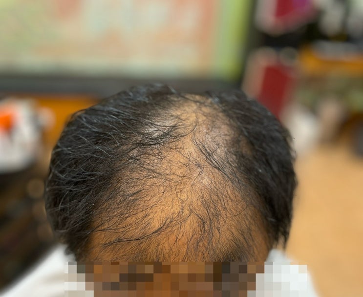  대머리남자탈모고민끝에내린결정 탈모커버성형펌 부산사상방송나온탈모전문미용실르네시떼6층에서 했어요!