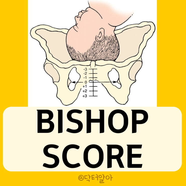  Bishop score (비숍 점수)의 정의, 구성, 해석, 활용, 한계