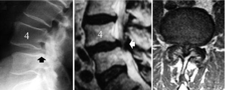 요추 척추관 협착증(Lumbar Spinal Stenosis)