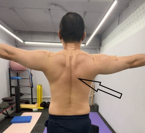  전거근(Serratus anterior) 운동과 장흉신경(Long thoracic nerve)[방배 PT]