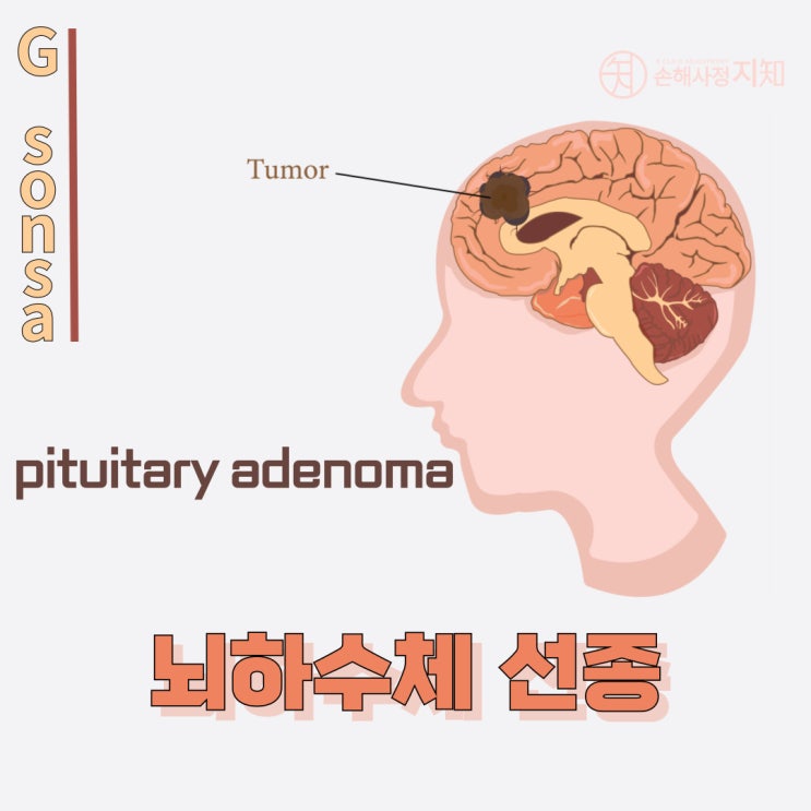  뇌하수체 선종 : 무엇을 알아야 할까요? - 〔아빠의 질병〕