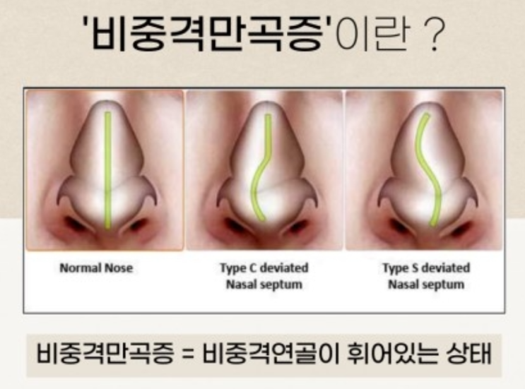  [성수한약국] 차가워진 날씨에 힘든 코막힘, 비염