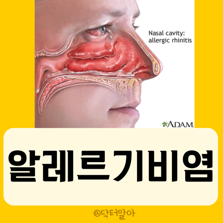  알레르기 비염 (Allergic rhinitis)의 정의, 증상, 분류, 진단 및 치료