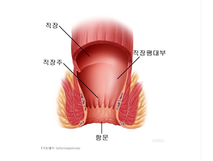  직장암 증상, 치료 과정, 장루 복원 수술 후유증, 중입자 치료