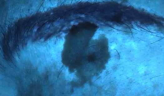  비싼 리팟 피부 레이저가 필요 없다고 생각하는 이유, 532nm 나노로 흑자 lentigo 제거하기, 당진/서산