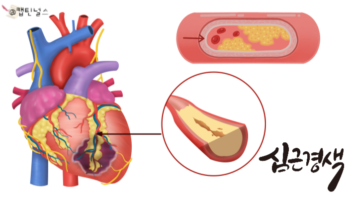STEMI와 NSTEMI 특징 및 EKG 차이점과 원인 및 치료 : 네이버 블로그
