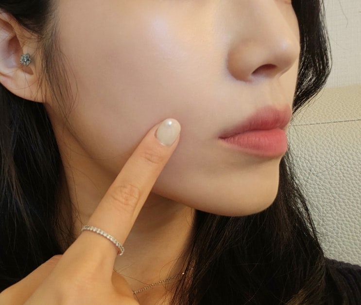  팔자주름리프팅 귀족침 한 달 후기