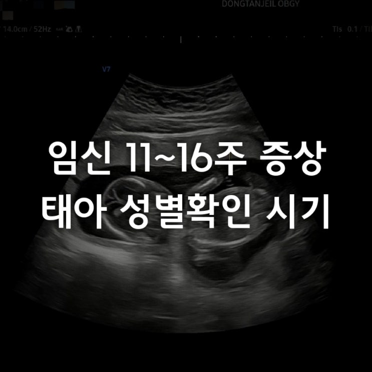  임신 11주 12주 13주 14주 15주 16주 증상 배통증 태아 성별 확인 시기