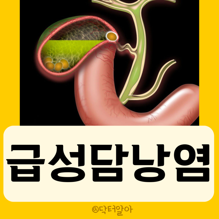 급성 담낭염 (Acute cholecystitis)의 정의, 원인, 증상, 진단 및 치료