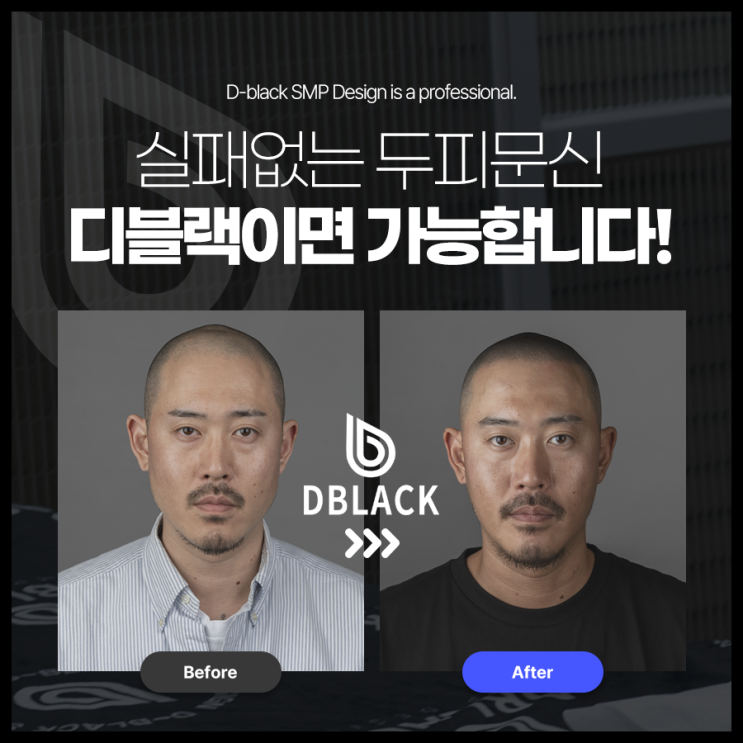  실패없는 두피 플랜팅을 위한 현명한 선택! (feat. 디블랙)