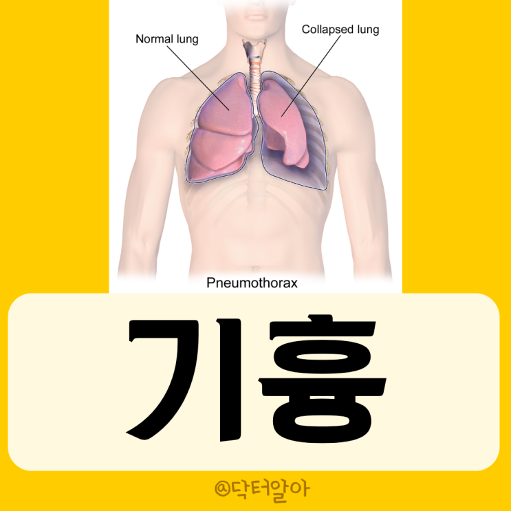  기흉(Pneumothorax)의 정의, 분류, 증상, 진단 및 치료
