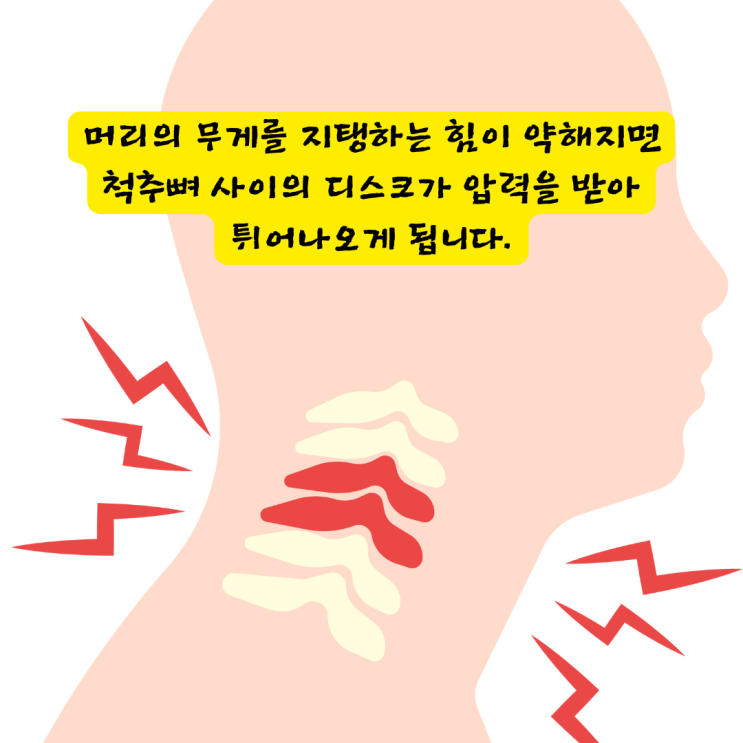  사직동정형외과, 목디스크 주사 맞아도 통증 계속되는 이유?