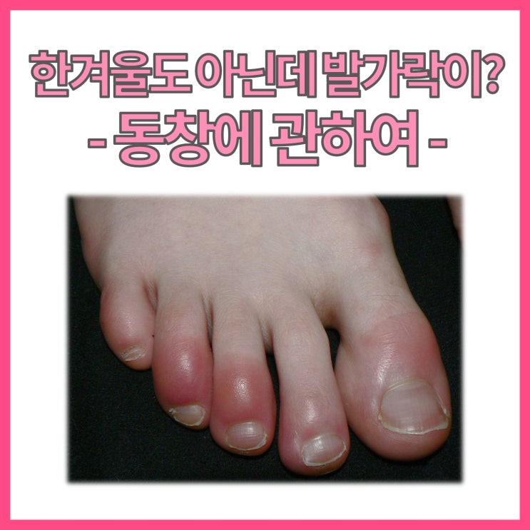  한겨울이 오기 전에 꼭 알아야 할, 동창 (chilblain)에 관하여