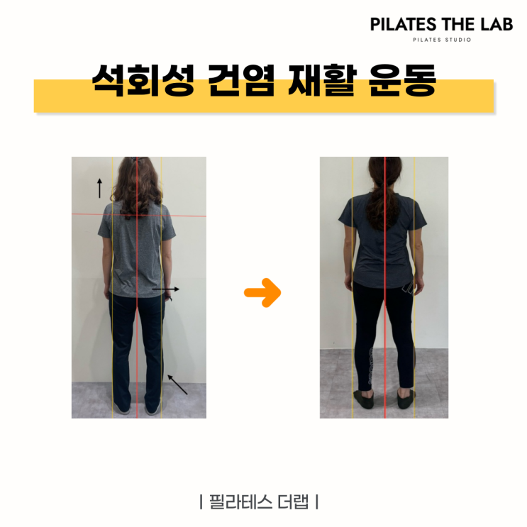  목동 필라테스 석회성 건염 재활 운동 후기