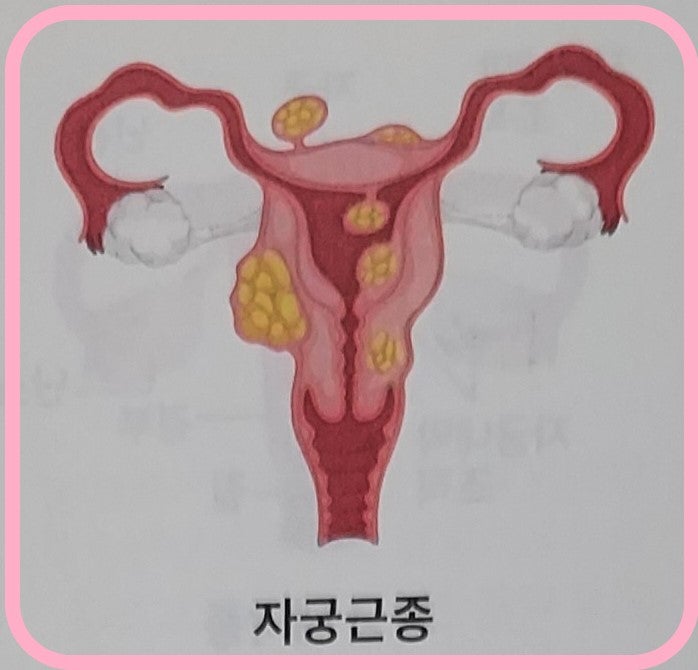 자궁근종, 자궁선근종 / 하이푸 시술 비급여