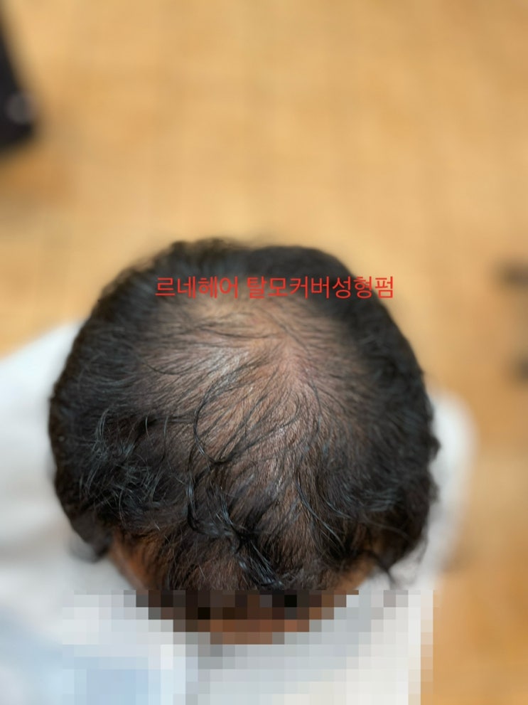  M자탈모와정수리넓은탈모 곱슬에길이짧은 남자탈모커버펌도전기 이곳은 부산사상르네시떼미용실/  감전학장김해녹산장유하단거제밀양진주창원사천울산양산연제수영망미남포민락용호해운대동래명륜사직장전