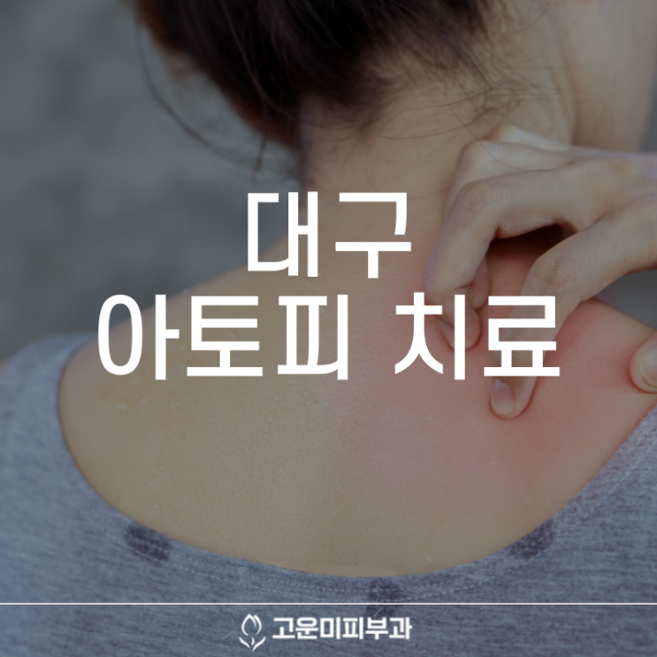  대구아토피치료 춥고 건조해지면 더 심해지는 아토피 치료와 관리