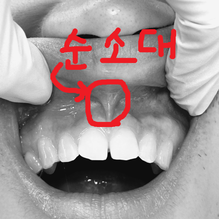  교정 후 앞니 벌어짐? 장치를 잘 착용했다면 '이것' 때문일 수도 있습니다