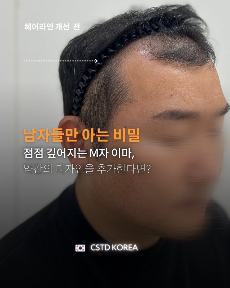  광주 남자 헤어라인 문신 가격 및 효과