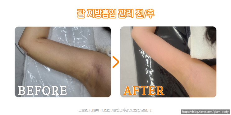  팔뚝 지방흡입 후 붓기와 바본 관리의 중요성!