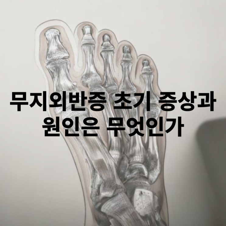  무지외반증 초기 증상과 교정기 후기