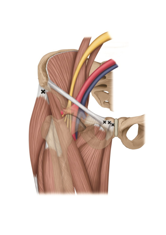  [의학 일러스트] 통증_골반 [Medical Illustration] Pain_Pelvis