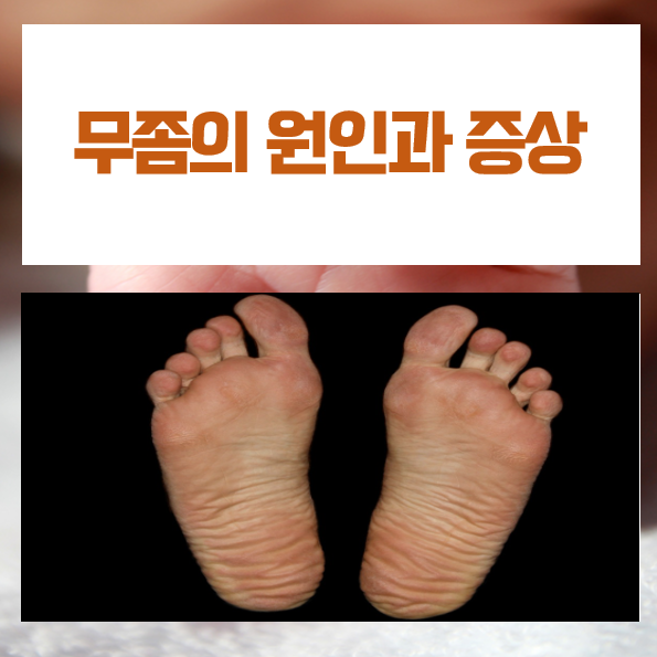  발 건강 위협! 무좀을 방치하면 발생하는 위험