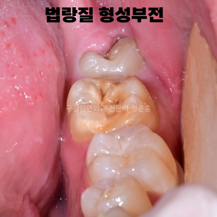  갈색? 노란치아? 때문에 웃는게 신경 쓰인다면 읽어보세요