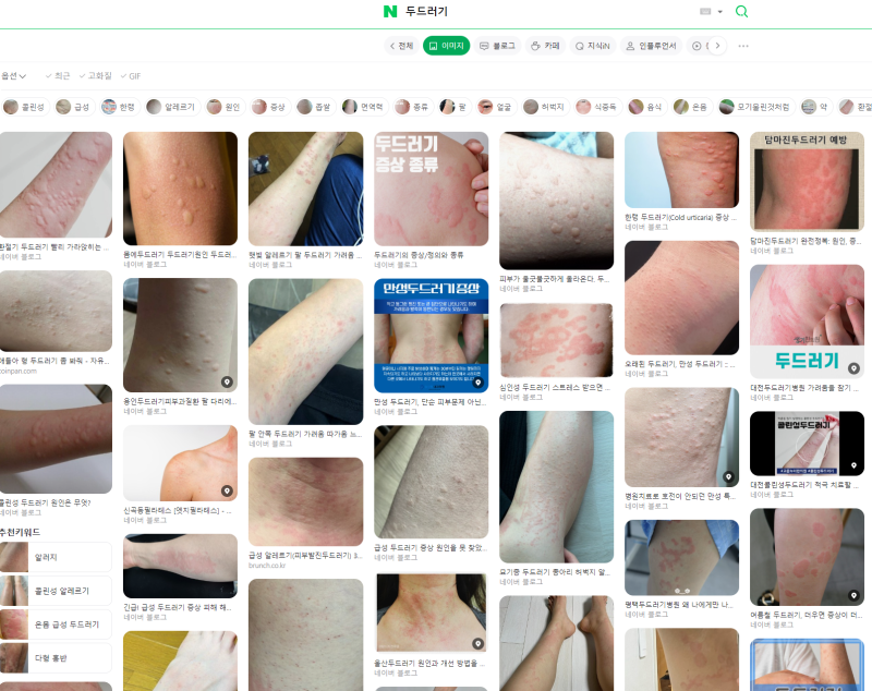 두드러기 한약 화곡동 이목한의원