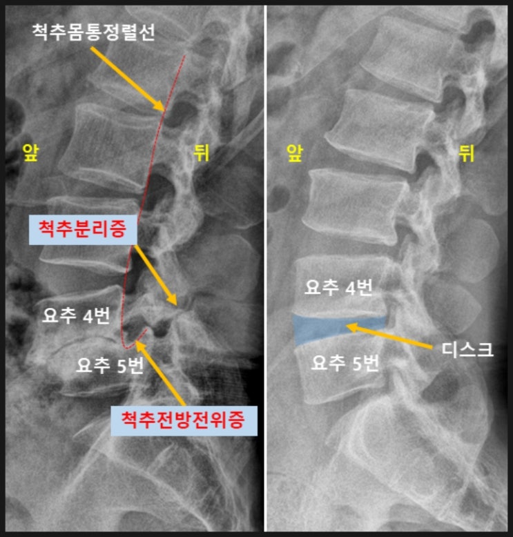  허리디스크 통증 완화, 치료를 받는데도 효과가 없다면?