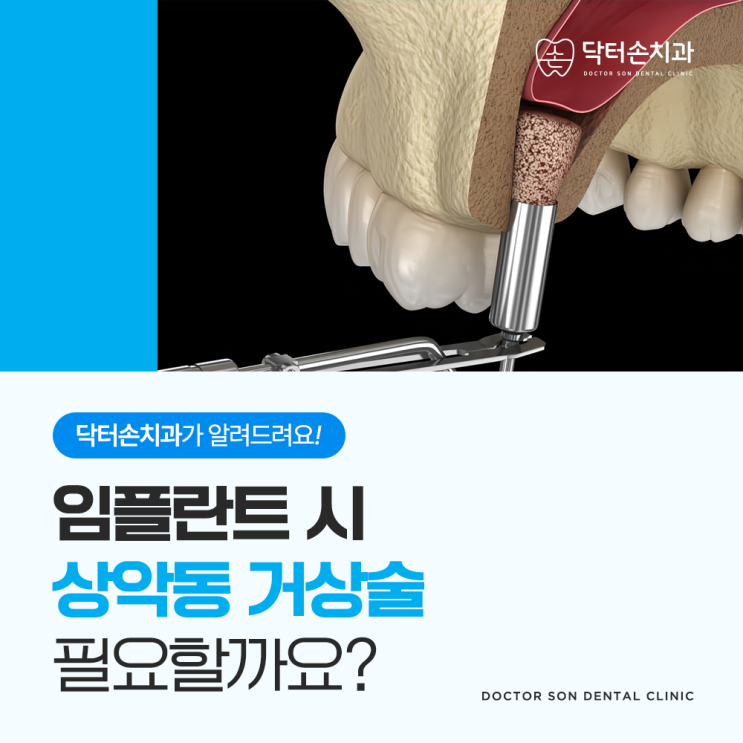  임플란트를 할 때 상악동 거상술이 필요하나요? 임플란트를 바로 심을 수는 없나요?