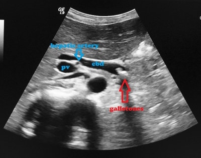 급성 담관염(Acute cholangitis)의 정의, 원인, 증상, 진단 및 치료 : 네이버 블로그