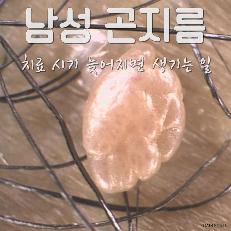남성 곤지름 사진 확인 후, 비슷한 게 발생했다면?